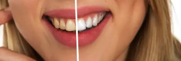 A before-and-after comparison showing relieve pain and yellow teeth on one side and bright white teeth on the other to illustrate dental whitening.